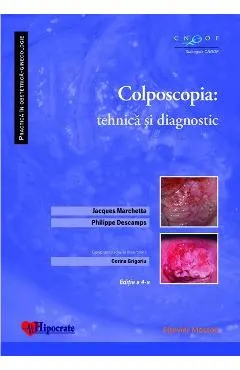 Colposcopia: tehnica si diagnostic