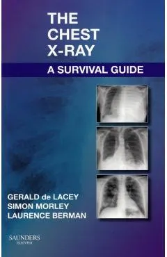 Chest X-Ray: A Survival Guide