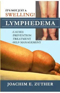 It's Not Just a Swelling! Lymphedema: Causes, Prevention, Treatment, Self-Management