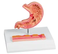 Stomac cu etapele Gastritei și Ulcerului – Model Anatomic